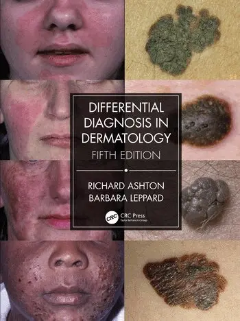 Differential Diagnosis in Dermatology