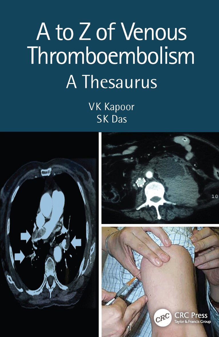 VK Kapoor, SK Das - to Z of Venous Thromboembolism, Häftad. Tillgänglighet: Lägg i varukorg