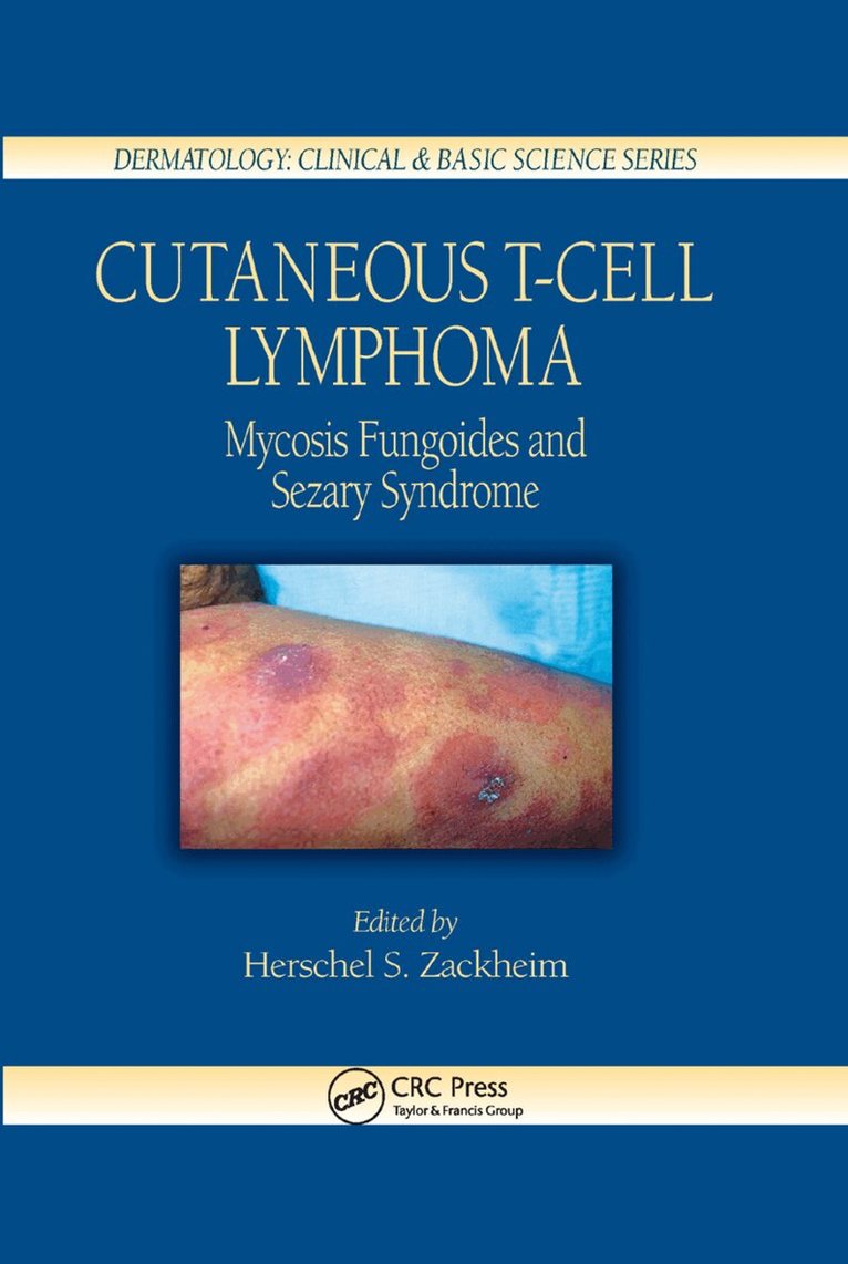 Herschel S. Zackheim - Cutaneous T-Cell Lymphoma, Häftad. Tillgänglighet: Lägg i varukorg