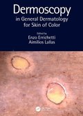 Dermoscopy in General Dermatology for Skin of Color