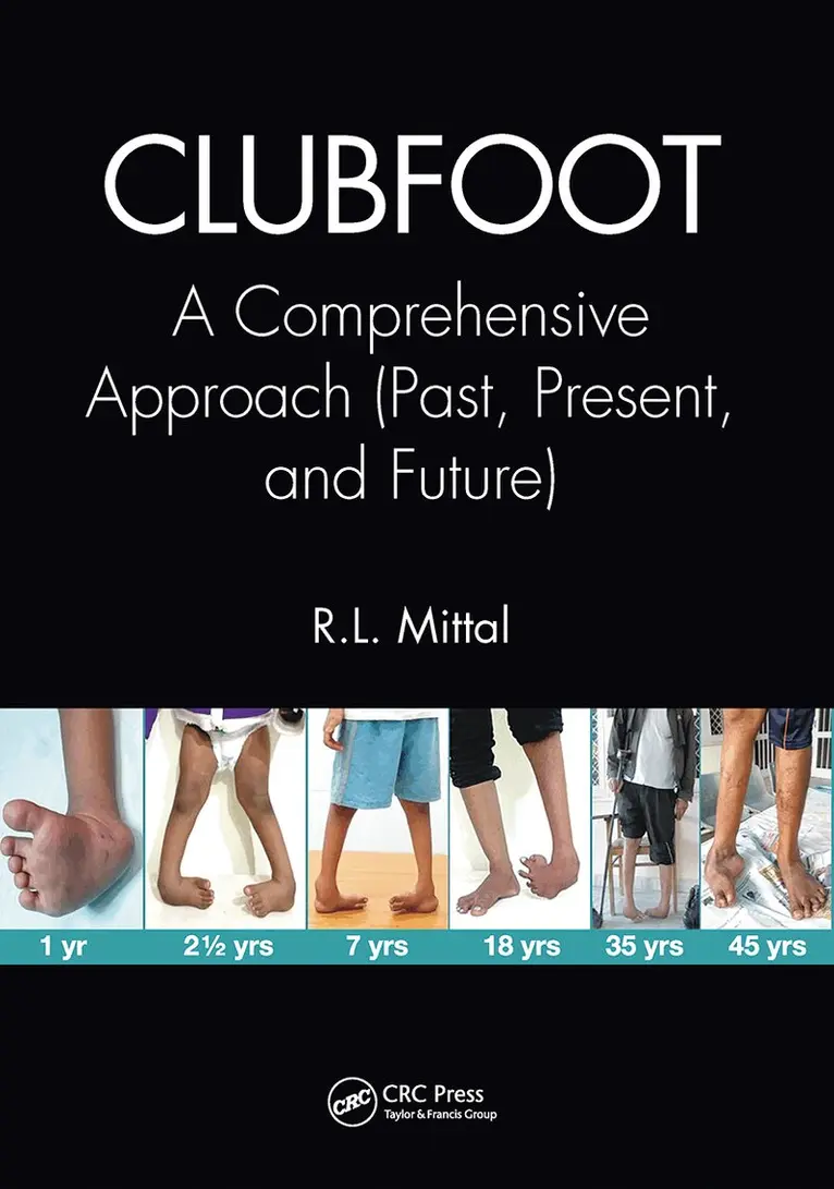 Clubfoot