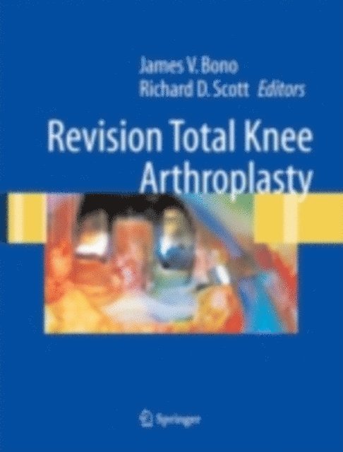 Richard D. Scott, James V. Bono - Revision Total Knee Arthroplasty, E-bok. Tillgänglighet: Lägg i varukorg