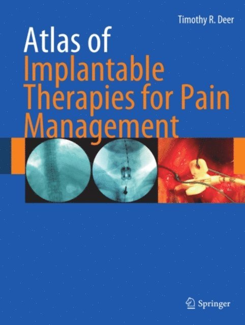 Timothy R Deer - Atlas of Implantable Therapies for Pain Management, E-bok