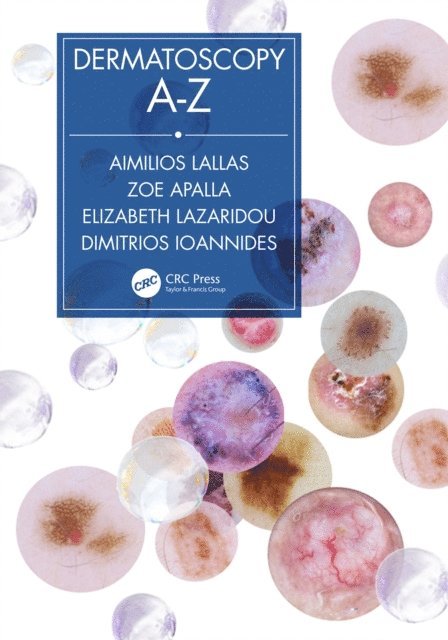 Dimitrios Ioannides, Elizabeth Lazaridou, Zoe Apalla, Aimilios Lallas - Dermatoscopy A-Z, E-bok