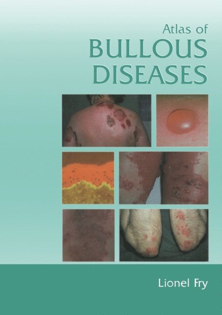 Lionel Fry - Atlas of Bullous Diseases, E-bok