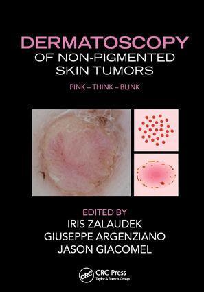 Iris Zalaudek, Giuseppe Argenziano, Jason Giacomel - Dermatoscopy of Non-Pigmented Skin Tumors, E-bok