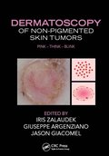Dermatoscopy of Non-Pigmented Skin Tumors