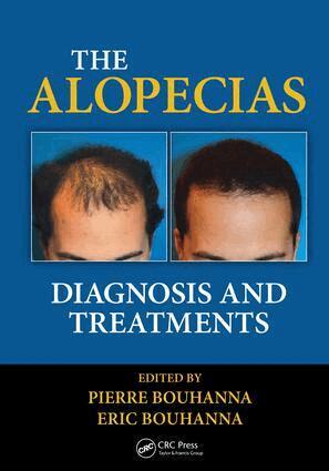 Pierre Bouhanna, Eric Bouhanna - Alopecias, E-bok