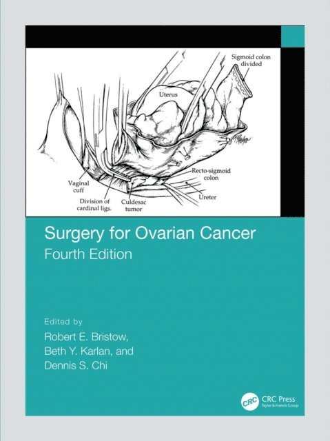 Dennis Chi, Beth Karlan, Robert Bristow - Surgery for Ovarian Cancer, E-bok