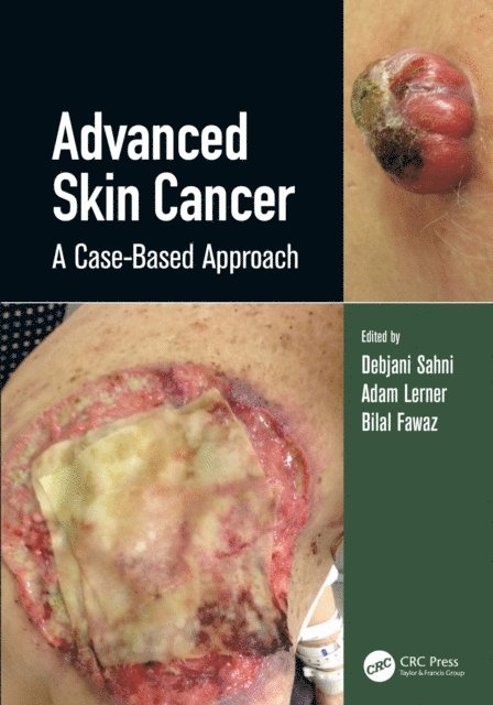 Adam Lerner, Debjani Sahni - Advanced Skin Cancer, E-bok