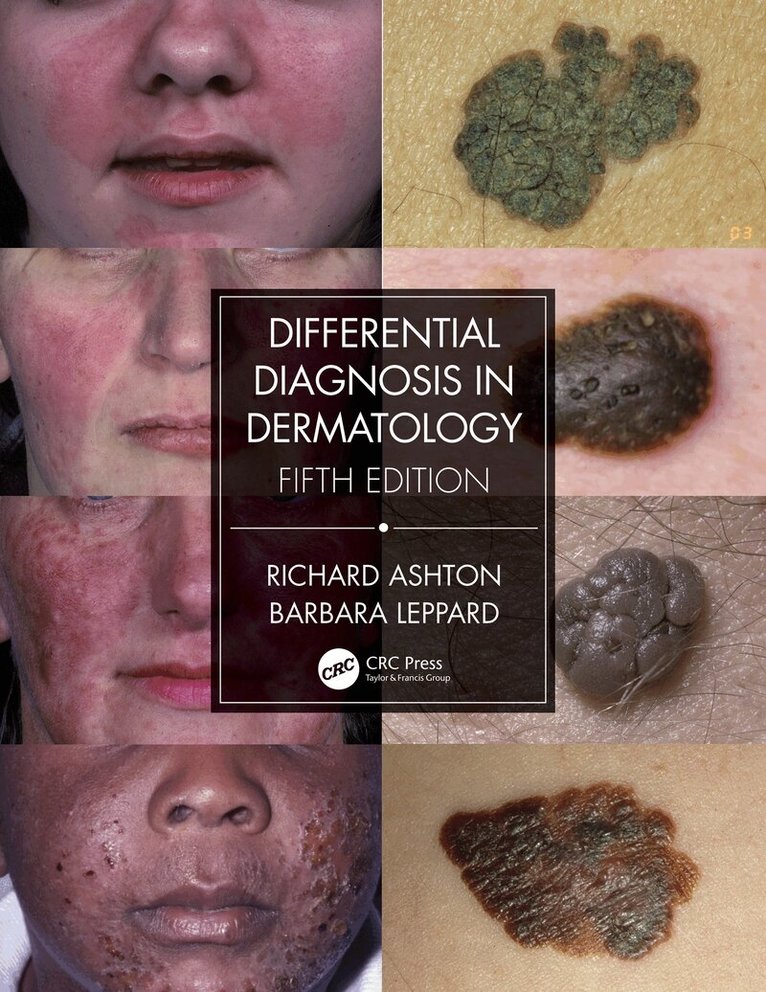 Richard Ashton, Barbara Leppard - Differential Diagnosis in Dermatology, E-bok