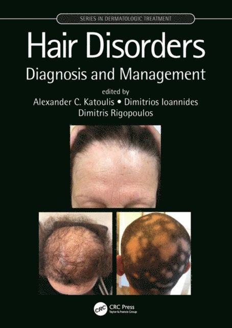 Dimitris Rigopoulos, Dimitrios Ioannides, Alexander C. Katoulis - Hair Disorders, E-bok