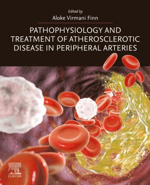 Aloke Virmani Finn - Pathophysiology and Treatment of Atherosclerotic Disease in Peripheral Arteries, E-bok. Tillgänglighet: Lägg i varukorg