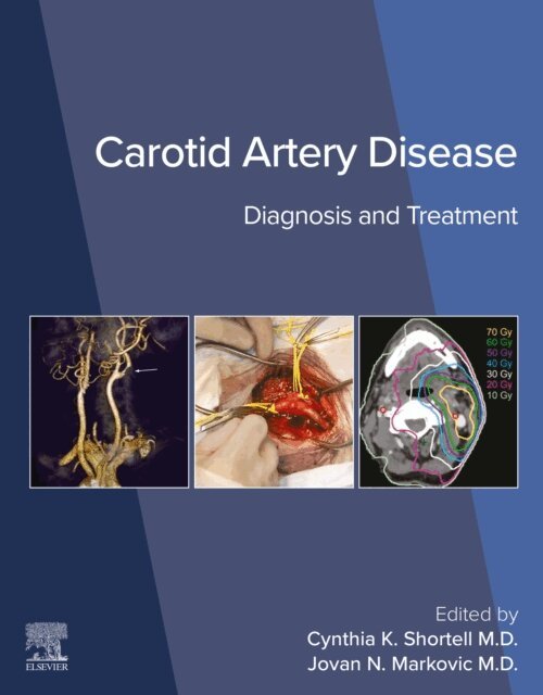 Jovan N. Markovic, Cynthia K. Shortell - Carotid Artery Disease, E-bok
