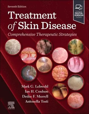 Mark Lebwohl, Ian H. Coulson, Dedee Murrell, Antonella Tosti - Treatment of Skin Disease, Inbunden
