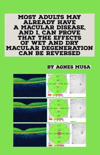 Agnes Musa - Most Adults May Already Have A Macular Disease, And I, Can Prove That The Effects Of Wet And Dry Macular Degeneration Can Be Reversed, E-bok. Tillgänglighet: Lägg i varukorg