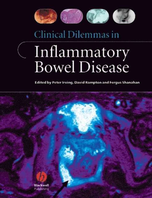 Fergus Shanahan, David Rampton, MRCP Peter Irving, MD - Clinical Dilemmas in Inflammatory Bowel Disease, E-bok