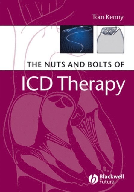 Tom Kenny - Nuts and Bolts of ICD Therapy, E-bok