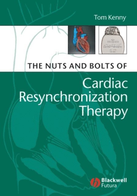 Tom Kenny - Nuts and Bolts of Cardiac Resynchronization Therapy, E-bok