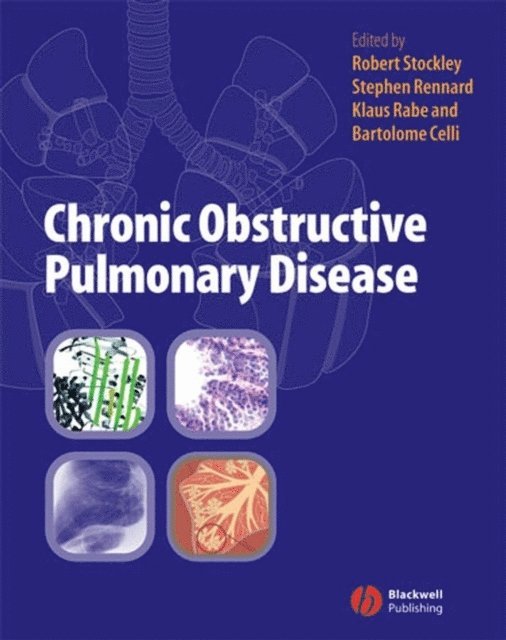Bartolome Celli, Klaus Rabe, Stephen I Rennard, Robert A. Stockley - Chronic Obstructive Pulmonary Disease, E-bok