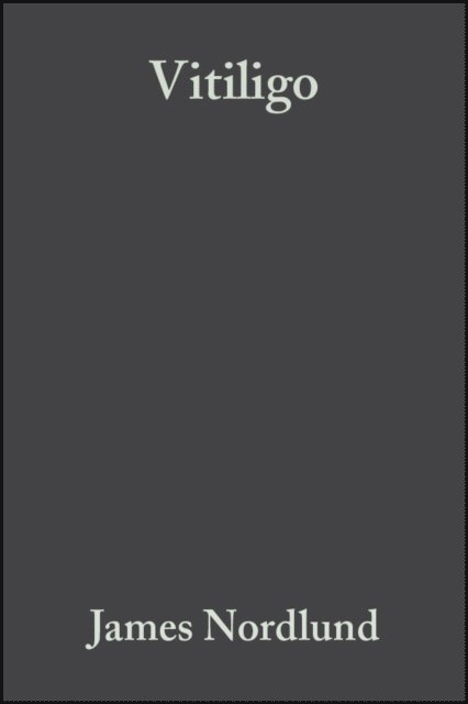 Vitiligo