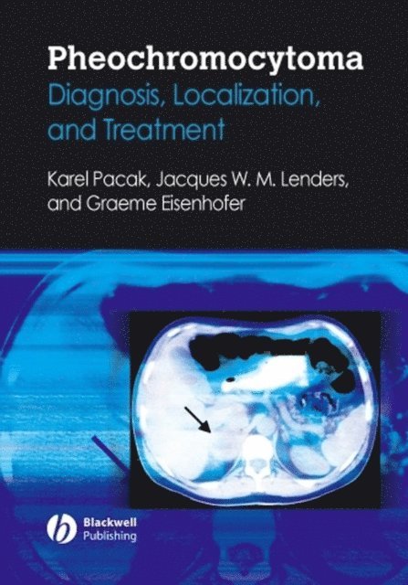 Jacques Lenders, Graeme Eisenhofer, Karel Pacak - Pheochromocytoma, E-bok