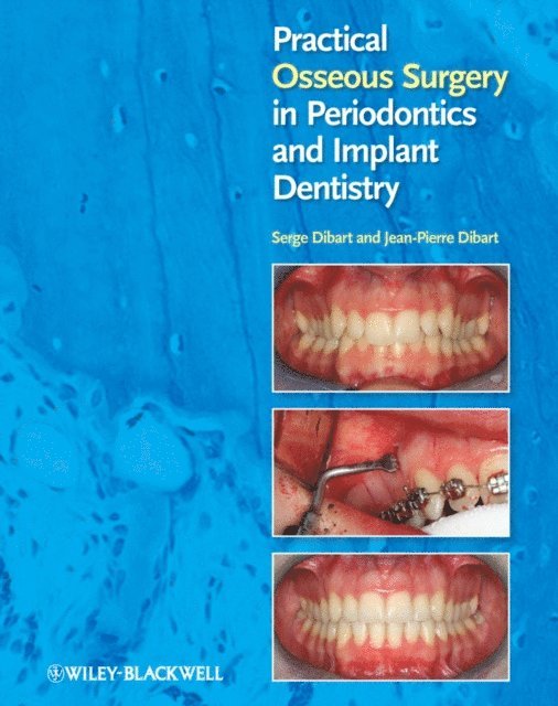 Jean-Pierre Dibart, Serge Dibart - Practical Osseous Surgery in Periodontics and Implant Dentistry, E-bok