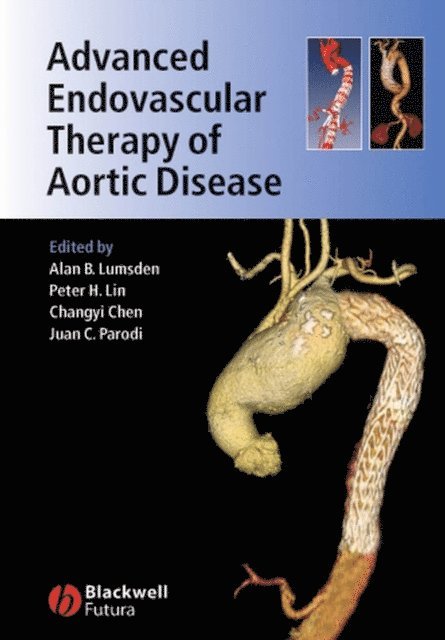 Juan Parodi, Changyi Chen, Peter H. Lin, Alan B. Lumsden - Advanced Endovascular Therapy of Aortic Disease, E-bok
