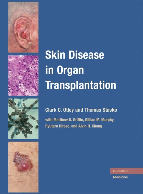 Clark C. Otley, Thomas Stasko - Skin Disease in Organ Transplantation, Inbunden