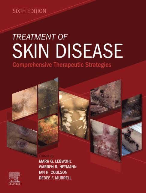 Dedee Murrell, Ian H. Coulson, Mark Lebwohl, Warren R. Heymann - Treatment of Skin Disease E-Book, E-bok