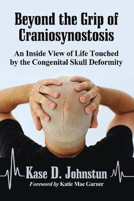 Beyond the Grip of Craniosynostosis