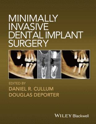 Daniel R. Cullum, Douglas Deporter - Minimally Invasive Dental Implant Surgery, Inbunden