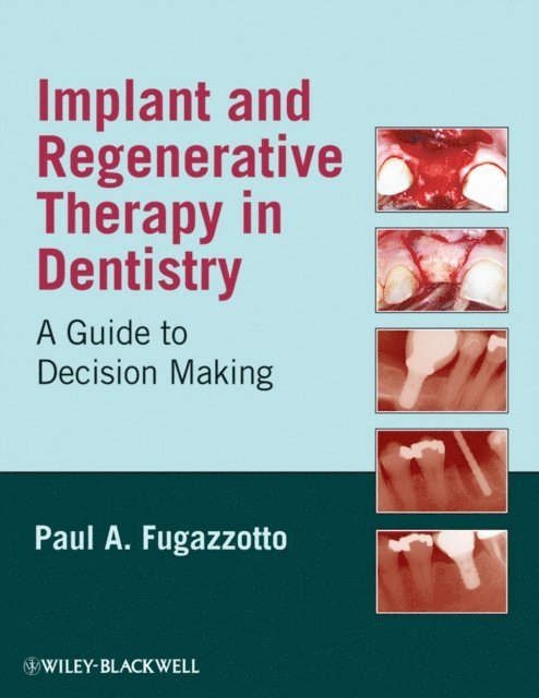 Paul A. Fugazzotto - Implant and Regenerative Therapy in Dentistry, E-bok. Tillgänglighet: Lägg i varukorg