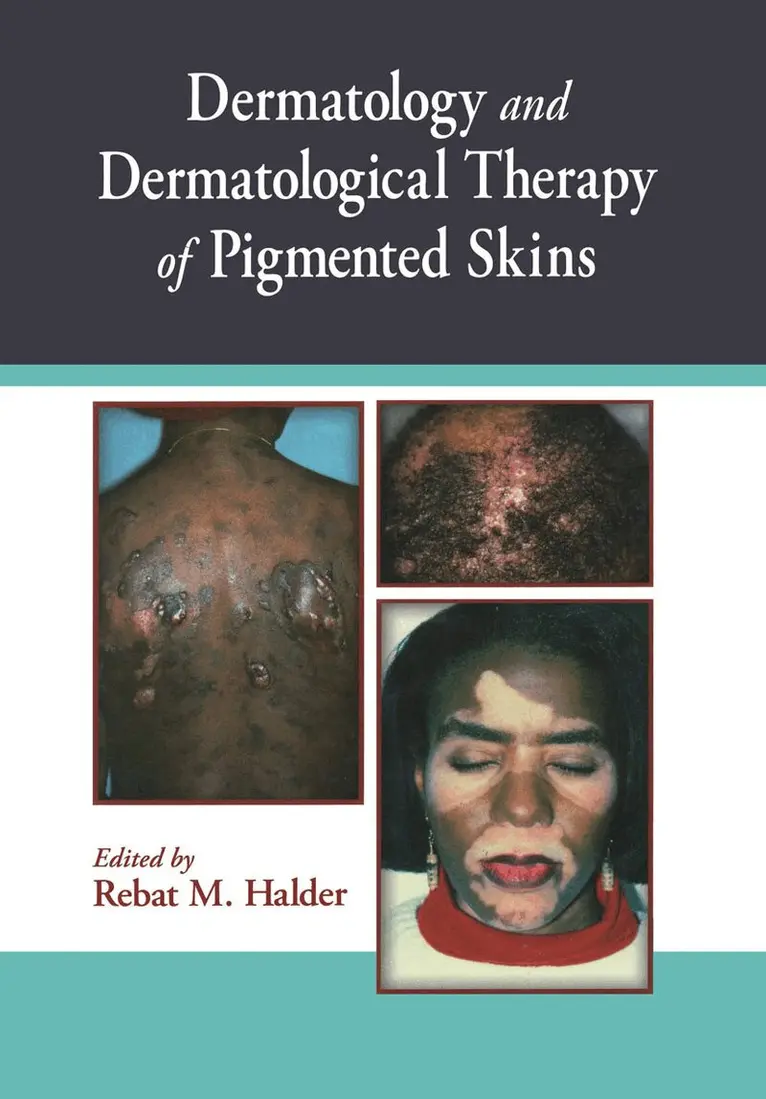 Rebat Halder - Dermatology and Dermatological Therapy of Pigmented Skins, Inbunden. Tillgänglighet: Tillfälligt slut