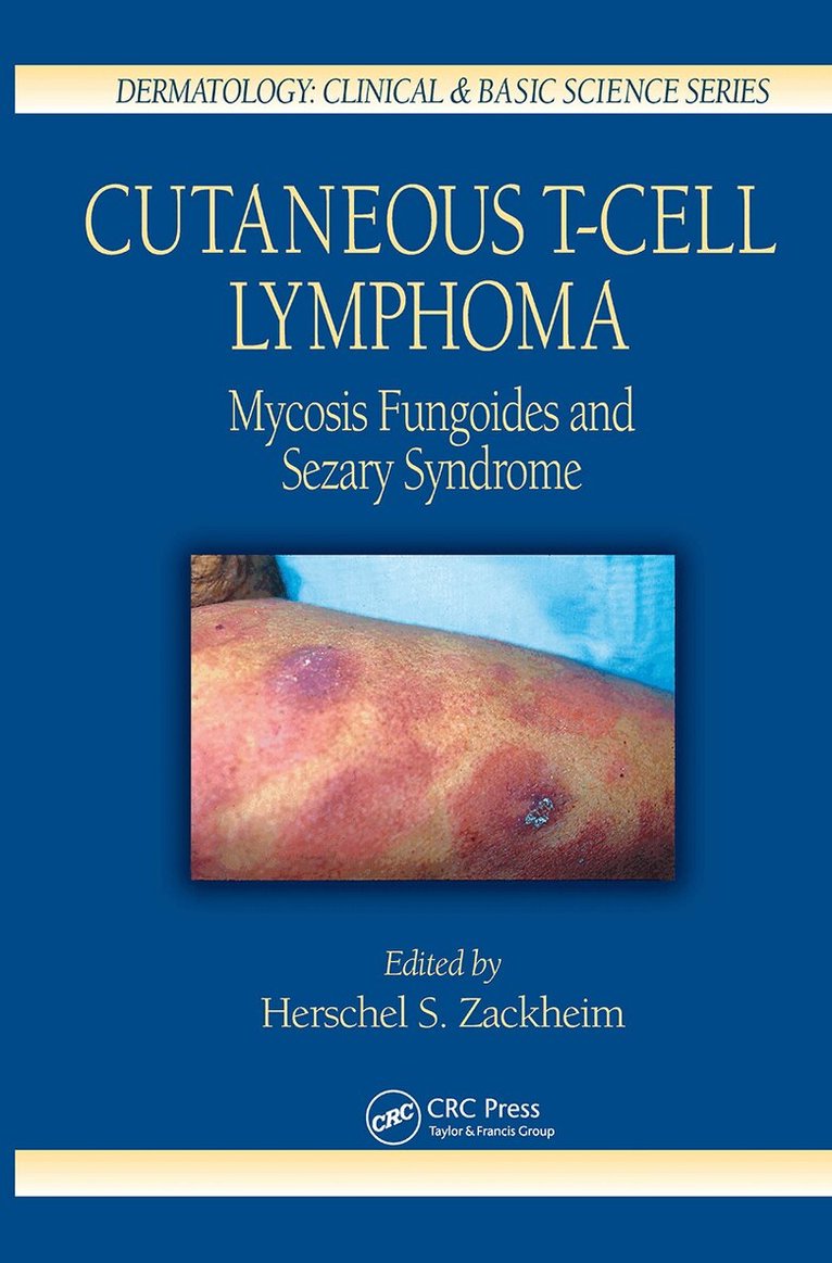 Herschel S. Zackheim - Cutaneous T-Cell Lymphoma, Inbunden. Tillgänglighet: Tillfälligt slut