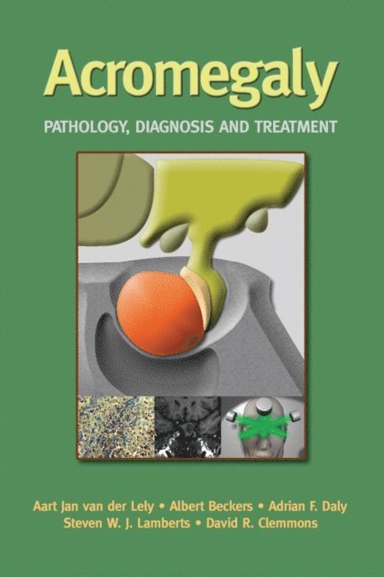 David R. Clemmons, Steven W. Lamberts, Adrian Daly, Albert Beckers, Aart Jan van der Lely - Acromegaly, E-bok