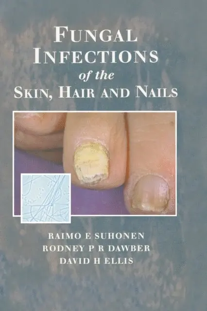 David H. Ellis, Rodney P.R. Dawber, Raimo E. Suhonen - Fungal Infections of the Skin and Nails, E-bok. Tillgänglighet: Lägg i varukorg