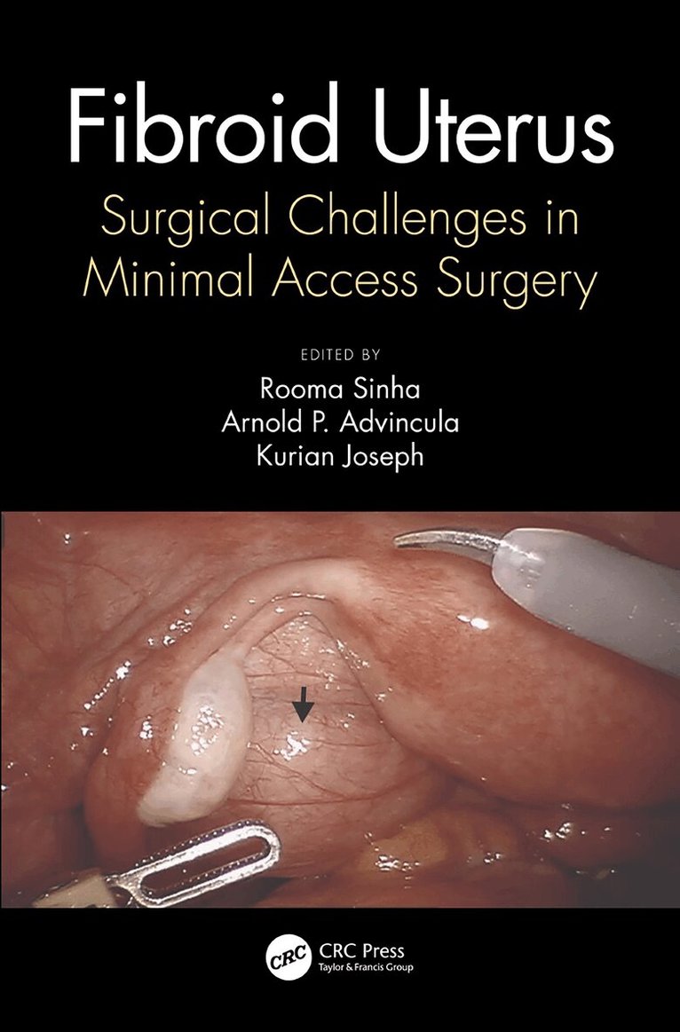 Rooma Sinha, Kurian Joseph, Arnold Advincula - Fibroid Uterus, E-bok