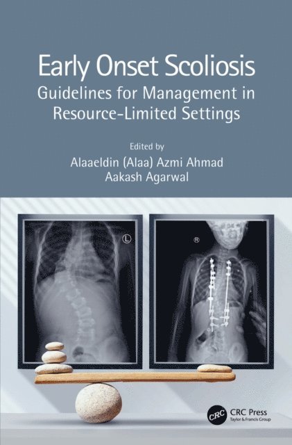 Aakash Agarwal, Alaaeldin  Azmi (Alaa) Ahmad - Early Onset Scoliosis, E-bok. Tillgänglighet: Lägg i varukorg