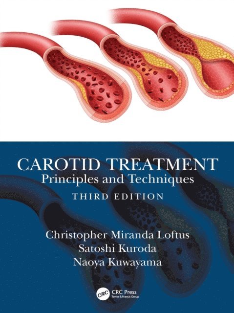 Naoya Kuwayama, Satoshi Kuroda, Christopher Miranda Loftus - Carotid Treatment: Principles and Techniques, E-bok