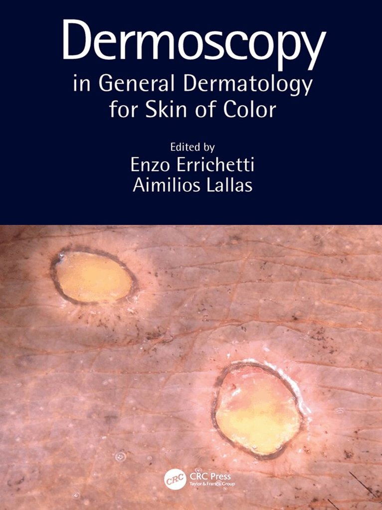 Enzo Errichetti, Aimilios Lallas - Dermoscopy in General Dermatology for Skin of Color, E-bok
