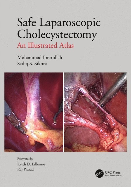Sadiq S Sikora, Mohammad Ibrarullah - Safe Laparoscopic Cholecystectomy, E-bok