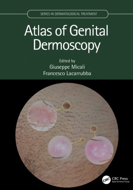 Francesco Lacarrubba, Giuseppe Micali - Atlas of Genital Dermoscopy, E-bok