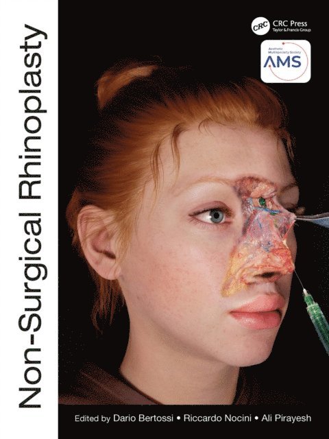 Ali Pirayesh, Riccardo Nocini, Dario Bertossi - Non-Surgical Rhinoplasty, E-bok