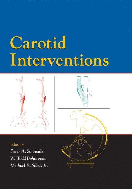 Michael Silva, Todd Bohannon, Peter Schneider - Carotid Interventions, E-bok