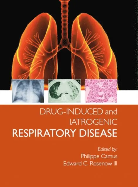 Drug-induced and Iatrogenic Respiratory Disease