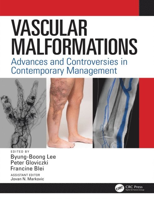 Francine Blei, Peter Gloviczki, Byung Boong Lee - Vascular Malformations, E-bok