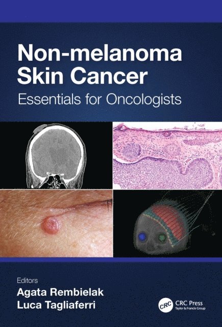 Luca Tagliaferri, Agata Rembielak - Non-melanoma Skin Cancer, E-bok