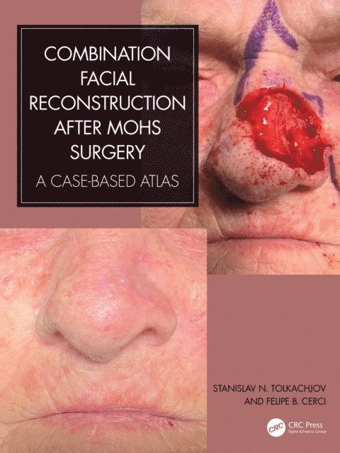 Felipe B. Cerci, Stanislav N. Tolkachjov - Combination Facial Reconstruction after Mohs Surgery, E-bok