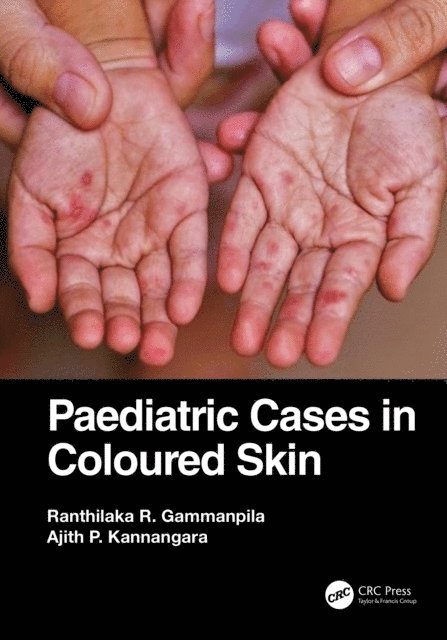 Ajith P. Kannangara, Ranthilaka R. Gammanpila - Paediatric Cases in Coloured Skin, E-bok